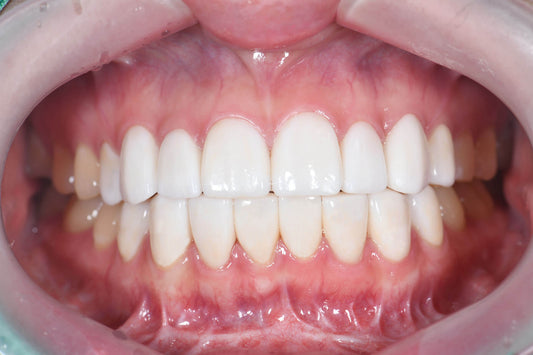 The K-Dental Guide to a Perfect Smile: Everything About Cosmetic Dentistry in Korea