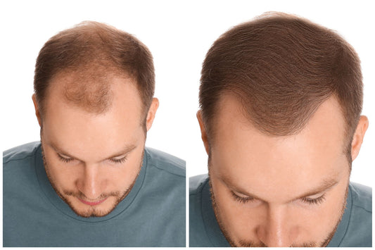 Hair Transplant in Korea: Best Clinics, Costs, and FUE/DHI Guide (2025)
